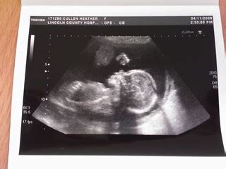 Baby Scan - 20 weeks | Ryan Cullen | Flickr