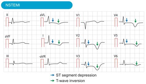 Classification Of Acute Coronary Syndromes Acs Acute Myocardial 12600 ...