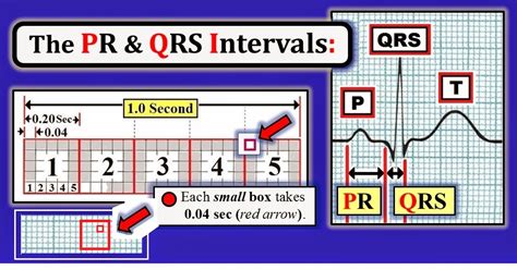 How To Measure Qrs Width