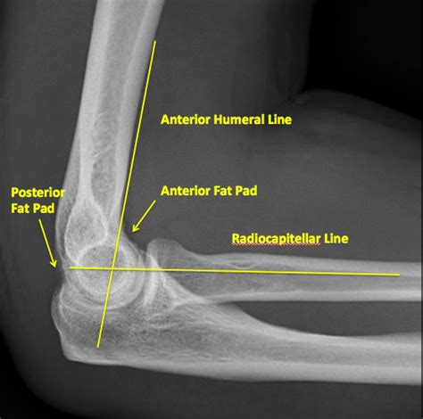 Abnormal Elbow X Ray