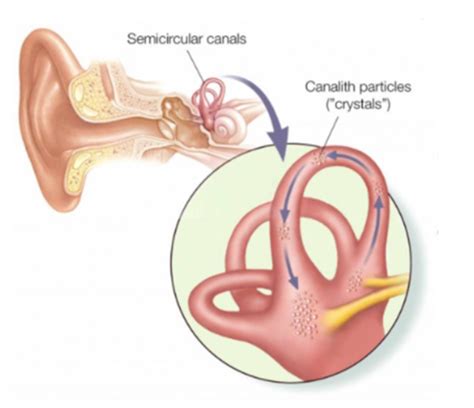 What is Benign Paroxysmal Positional Vertigo (BPPV)? - JHBI