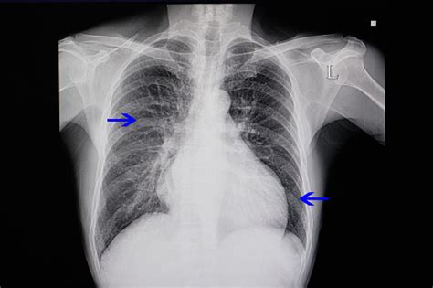 A Chest Xray Of A Patient With Heart Failure Stock Photo - Download ...