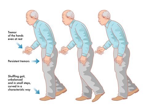 Forscher: Neuer Hirnschrittmacher hilft bei Parkinson – Heilpraxis