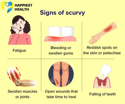 Scurvy: Symptoms, Causes Treatment, 50% OFF