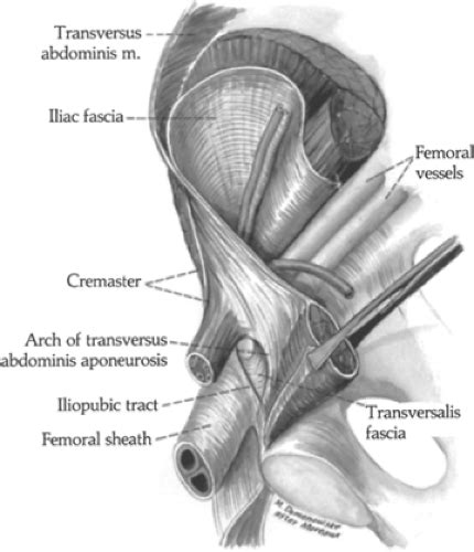 Iliopubic Tract Repair of Inguinal and Femoral Hernia: the Posterior ...