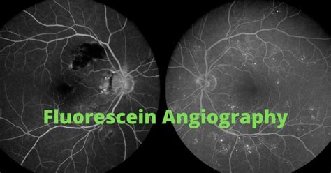 What is a Fluorescein Angiogram - Nader Moinfar, MD, MPH, FACS, FASRS