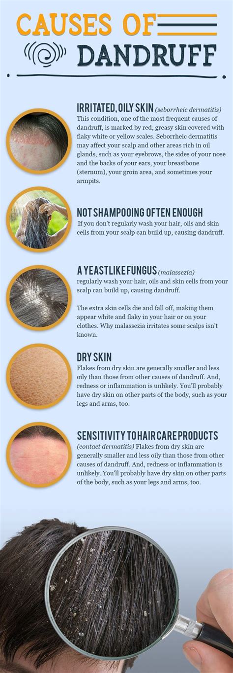 Discover what the causes of dandruff are. #HealthyBeauty #Causesof ...