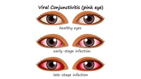 Conjunctivitis: Causes, how this viral eye infection spreads, treatment ...