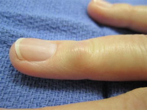 Photos of Mucous Cysts in Fingers - John Erickson, MD