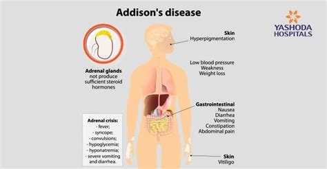 Adrenal Gland Disorders: Types, Causes, Symptoms, Diagnosis, Treatment ...