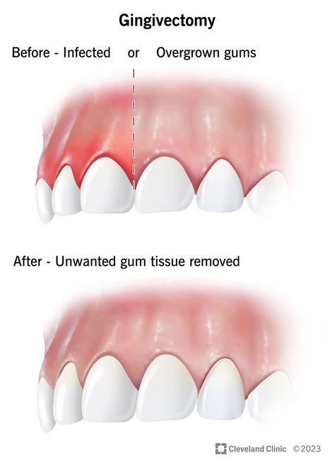 What is a Gingivectomy? Procedure & Recovery