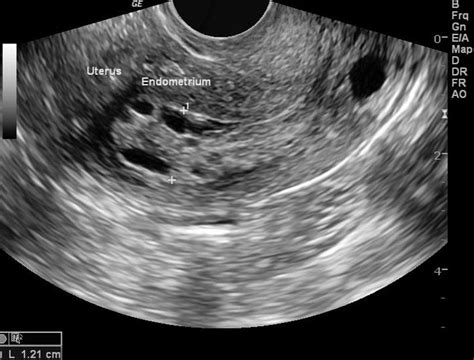 Endometrial hyperplasia ultrasound - wikidoc