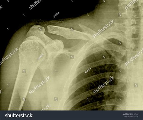 Radiography Clavicle Fracture Stock Photo 1289167744 | Shutterstock