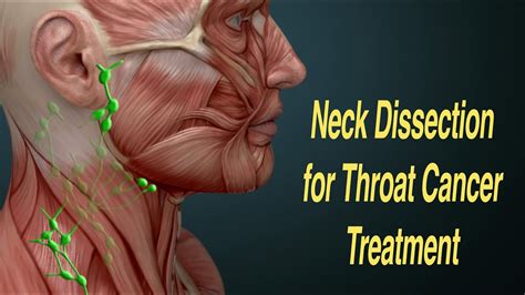 Neck Dissection Surgery for Throat Cancer Treatment (MRND, RND) - YouTube