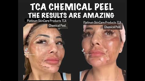 TCA Chemical Peel Amazing Results