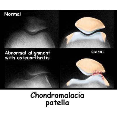 Chondromalacia Patella - eOrthopod.com