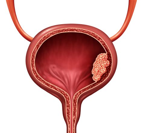 Improving the Chemo-Immunotherapy Response in Bladder Cancer