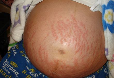 Puppp Rash - Pictures, Symptoms, Causes, Treatment, What is