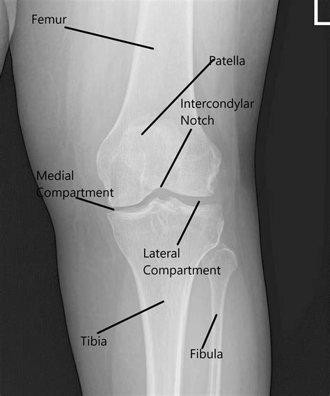 Case Study: Endobutton and Chondroplasty of Left Knee