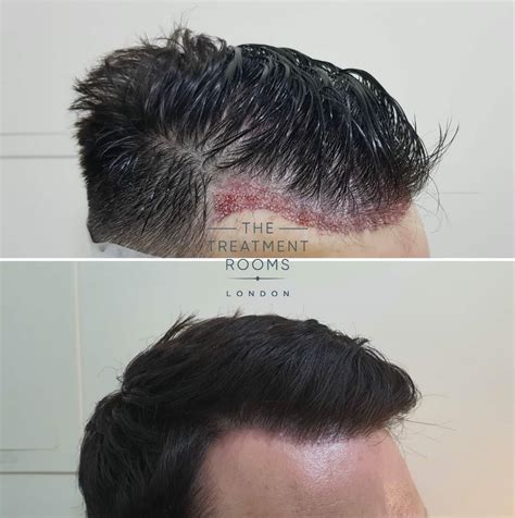 An In-Depth Guide To Receding Hairline Treatment