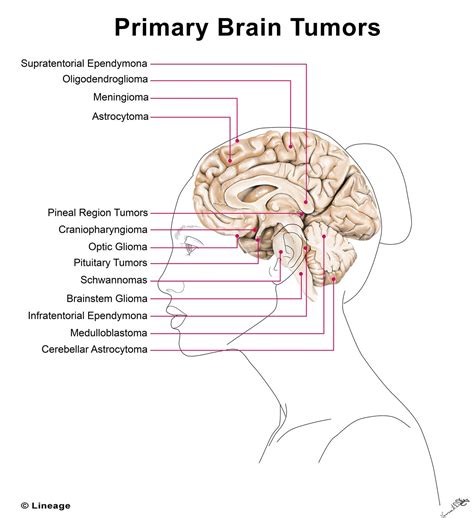 brain tumor size chart cm Tumor size millimeters cancer tamaño preview ...