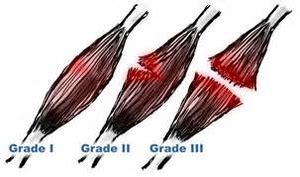 Muscle Strain - Physiopedia