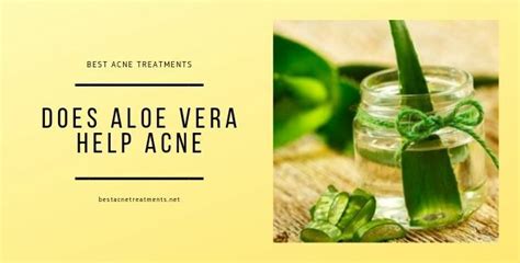 Does Aloe Vera Help Acne - Top Acne Treatments Review