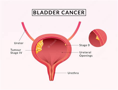 Bladder Cancer. Symptoms, Causes, Treatment. Line Icons Set - Clip Art ...