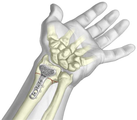 Volar Bearing Plate - Wrist Fracture Treatment - TriMed Inc.