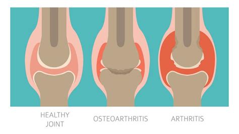 Rheumatoid Arthritis and Osteoarthritis: What is Common and How They ...