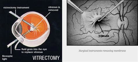 Epiretinal Membrane Surgery – Durban Retinal Associates