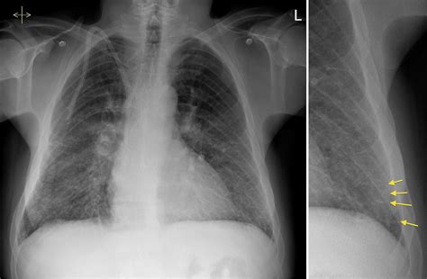 Pulmonary Edema X Ray / The preoperative chest X-ray showing pulmonary ...