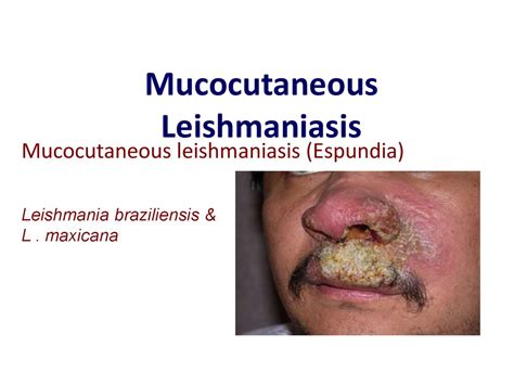 Mucosal Leishmaniasis