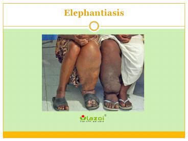 PPT – Elephantiasis: Causes, Symptoms and Treatment PowerPoint ...