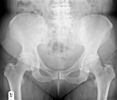 Osteoarthritis of hip joint, X-ray - Stock Image - C002/9629 - Science ...