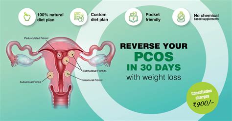 Reverse Your PCOS In 30 Days | Diet Plan To Lose Weight For PCOS