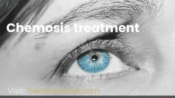 Chemosis Treatment/ Symptoms, Diagnosed, Treatment Healthsoothe