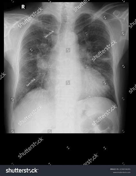 Chest Posteroanterior Xray Male Cough Stock Photo 2236536281 | Shutterstock