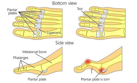 Plantar Plate Tear: Causes, Symptoms, and Treatment