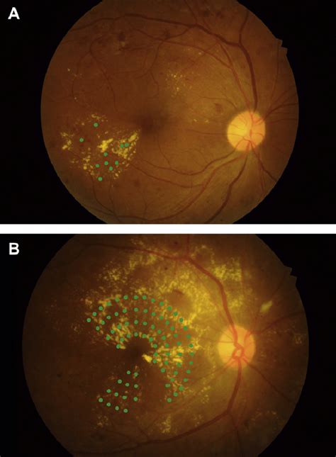 Kommunikationsnetzwerk Vermuten Reduktor Brunnen Trog Erbse macular ...