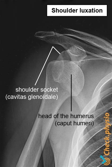 Shoulder subluxation | Physio Check