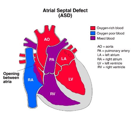 Atrial Septal Defect (ASD) Causes, Symptoms, Diagnosis and Treatment ...