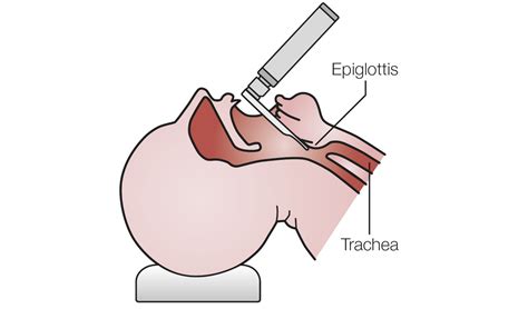 Anaesthesiology Application and Diagnostic Tips - HEINE Laryngoscope ...