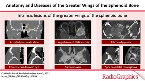 Sphenoid Bone Anatomy