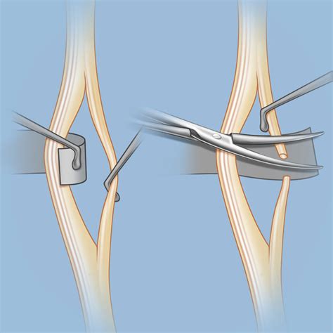 Surgery for Spasticity | Weill Cornell Brain and Spine Center