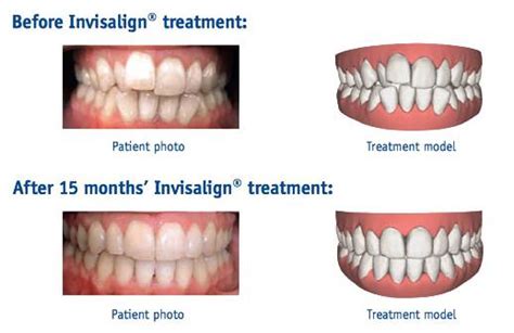 POWER OF INVISALIGN TREATMENT