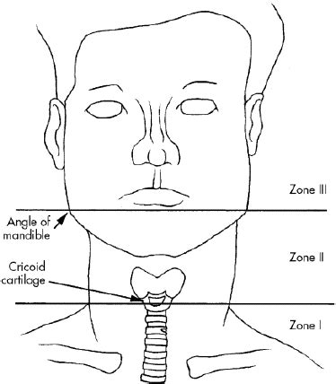 Neck Anatomical Zones for Cancer and Trauma | Surgery Blog, Calvin Lee ...