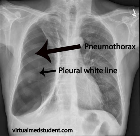 EpoportMengiau: A lil' bit of CXR