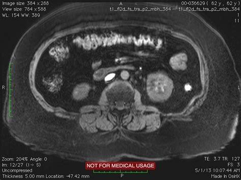 Renal cell carcinoma MRI - wikidoc