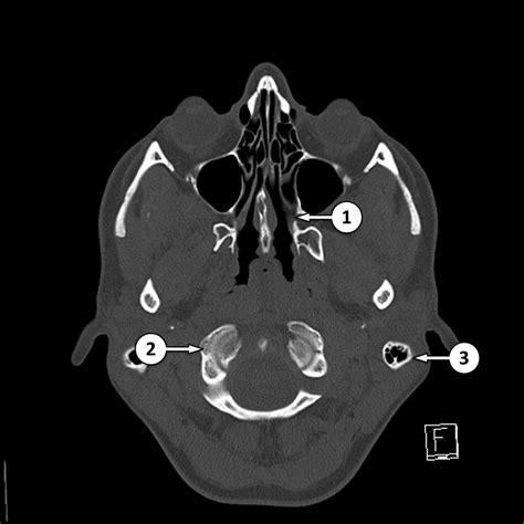 Sphenoid Bone Anatomy Ct